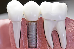 dental implant close up