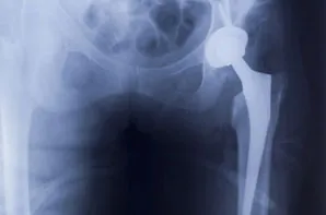 Artificial Hip Implant Prosthesis